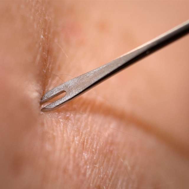 bifurcated needle