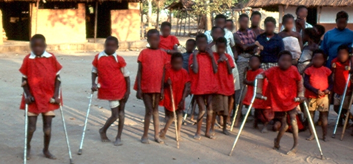Konzo survivors in Mozambique, 1981. Image courtesy of Julie Cliff