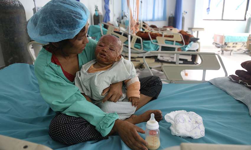 This baby boy, an only child, was playing with his grandmother and fell into a pot of boiling milk 3 days before the photo was taken. Image by Rojita Adhikari