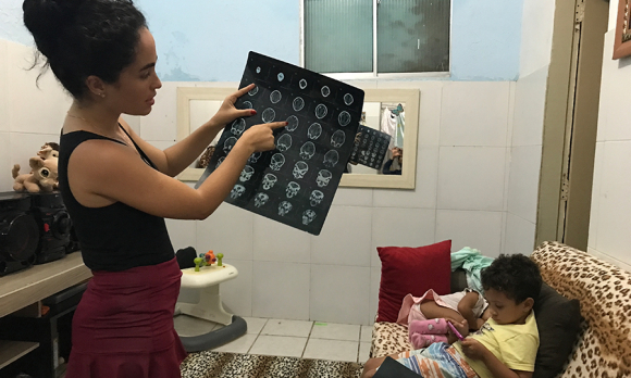 Dhulha Alen Silva do Nascimento, 25, has become skilled at reading and interpreting neuroimages since her youngest daughter, Valentina, was born nearly 2 years ago with congenital Zika syndrome.